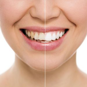 teeth-whitening