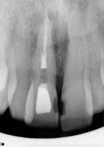 root_canal